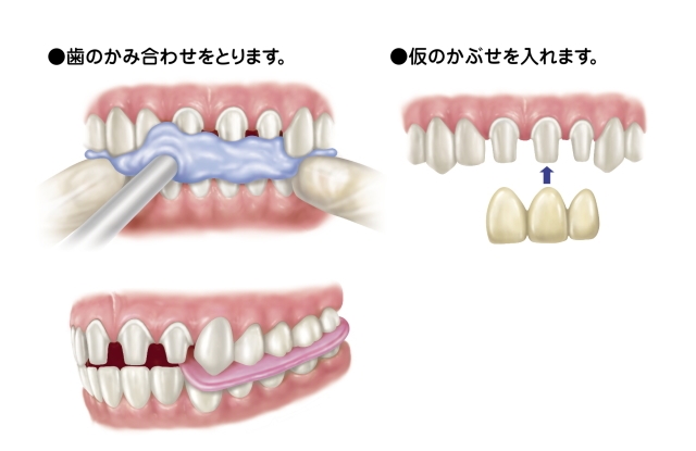 納得のいく差し歯