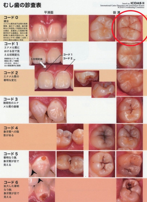 むし歯の診査表